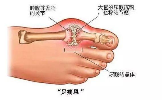 各年龄段血压、血糖、血脂、尿酸对照表，人人一份，值得收藏