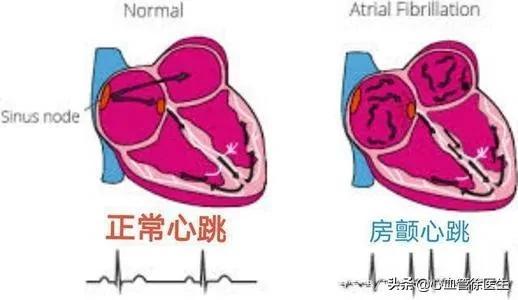 专家提醒：预防脑梗，不能忽视这种心脏疾病“房颤”