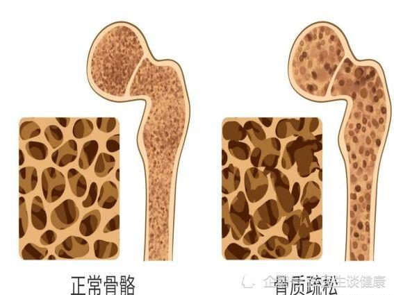 世卫组织呼吁：这“3白”不要再吃，骨骼已在一点点变“渔网”