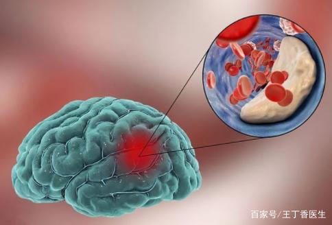 为何脑梗患者逐渐增多？或与3个习惯有关，劝你尽早戒掉