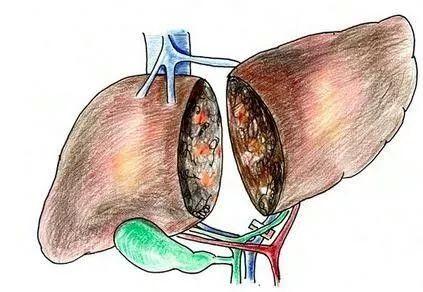 肝病先上脸，警惕肝脏发出的“求救信号”！
