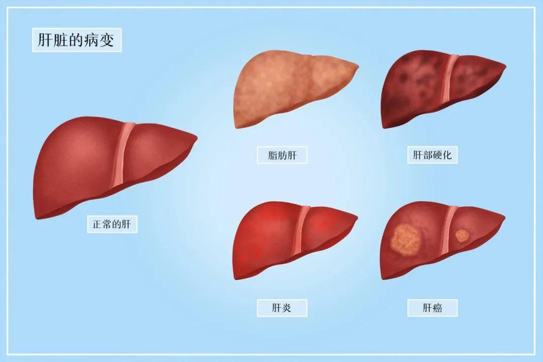 沉默的“杀手——非酒精性脂肪肝，一篇给你讲明白！