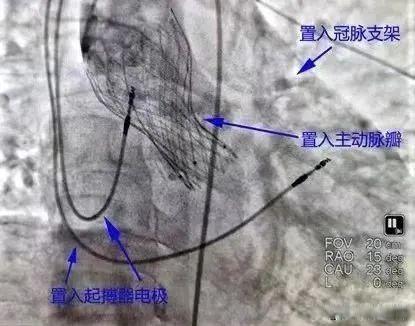 三大手术“修心” 心梗预防要重视