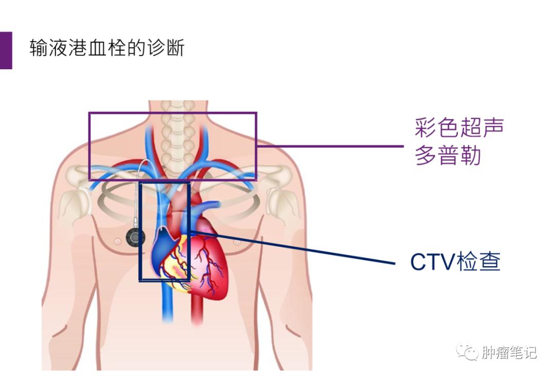 输液港相关血栓事件的预防及处理