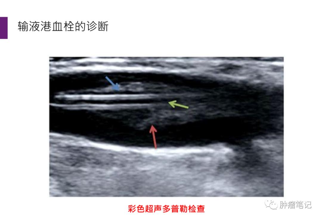 输液港相关血栓事件的预防及处理