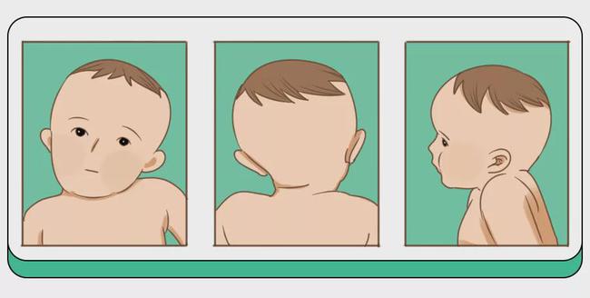 别再觉得宝宝“歪头杀”可爱了！伴随这4种表现，99%是斜颈！