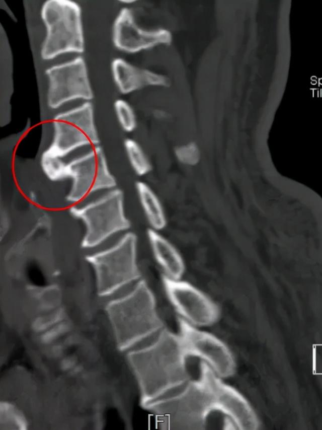 青岛62岁大爷咽不下饭，竟是颈椎骨上长了个“鸟嘴”