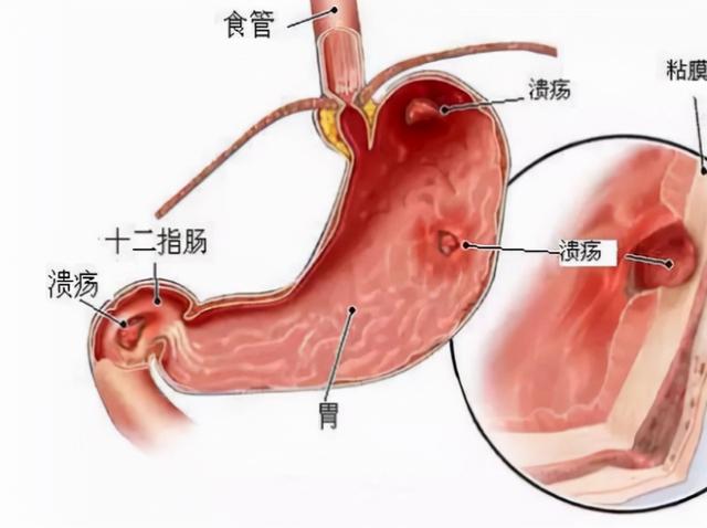 “奥美拉唑”要认清，只对4种病有效，建议了解