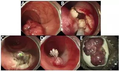 7 种方法轻松搞定结肠息肉