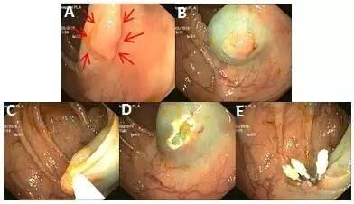 7 种方法轻松搞定结肠息肉