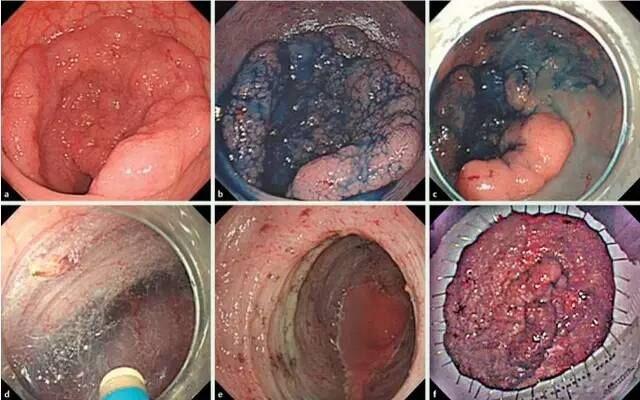 7 种方法轻松搞定结肠息肉