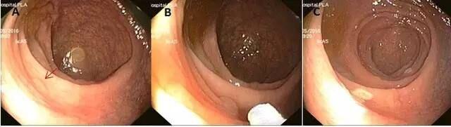 7 种方法轻松搞定结肠息肉