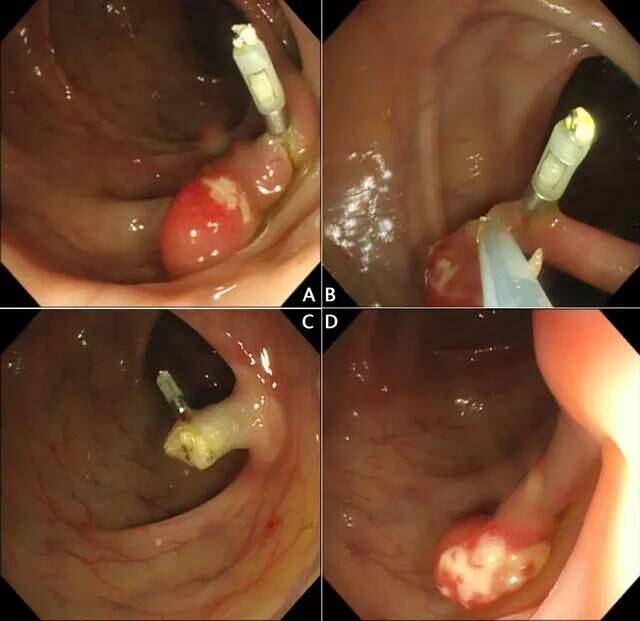 7 种方法轻松搞定结肠息肉