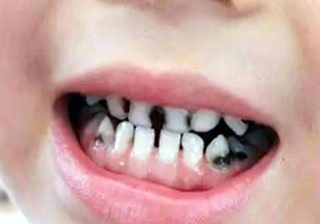孩子普遍烂牙，跟家长有直接关系，一个习惯养成轻松保护宝宝牙齿