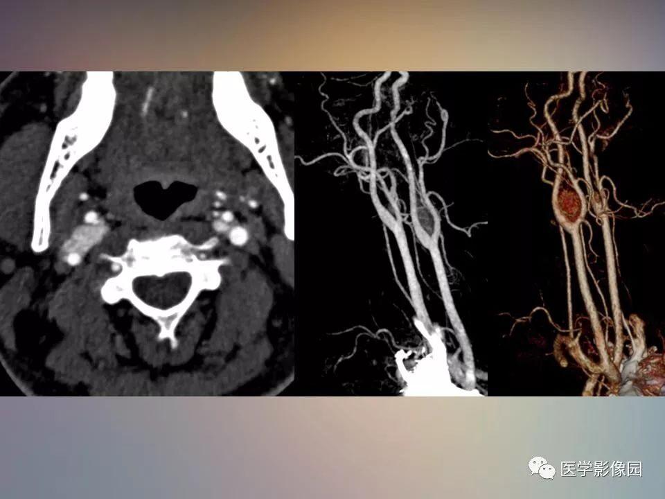 颈动脉分叉处实性占位的影像诊断