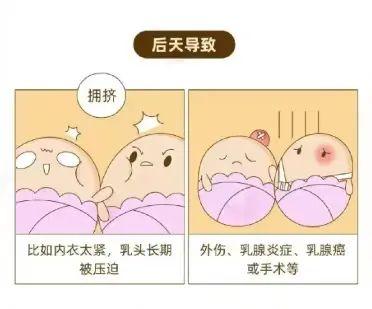 乳头凹进去了怎么办？会是乳腺癌吗？干货！