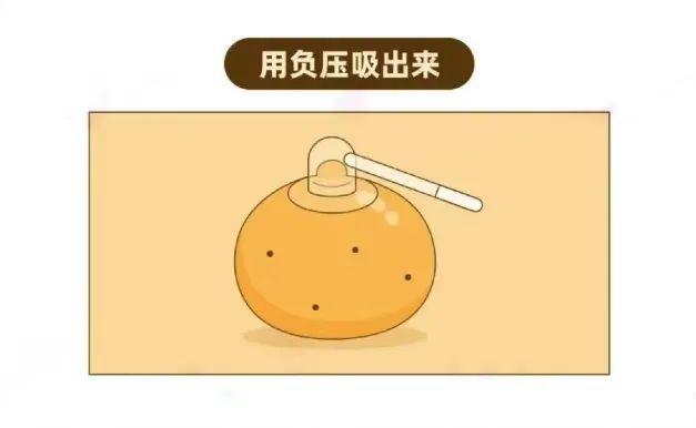 乳头凹进去了怎么办？会是乳腺癌吗？干货！