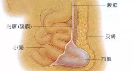 疝气不善，家有老人的要注意了