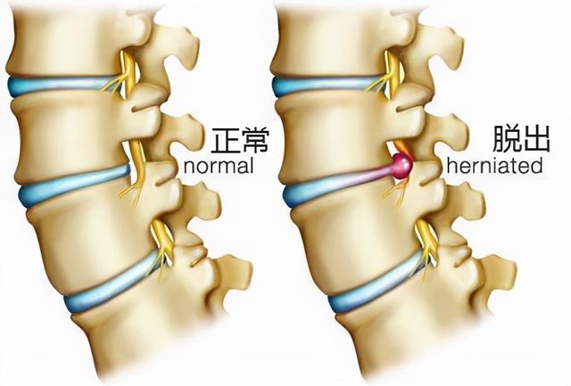 高三学生腰痛脚麻 原是旧伤诱发腰突