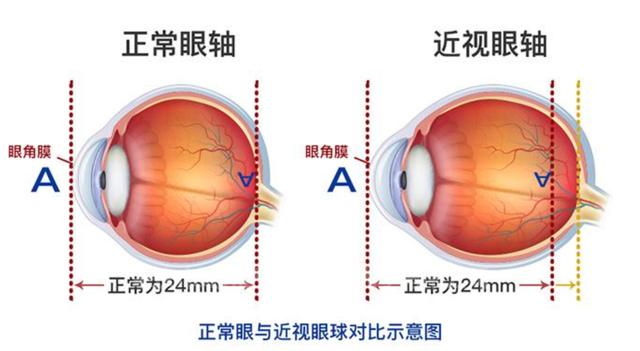 预告丨孩子爱走神，学习成绩下降？快带孩子查查视力吧