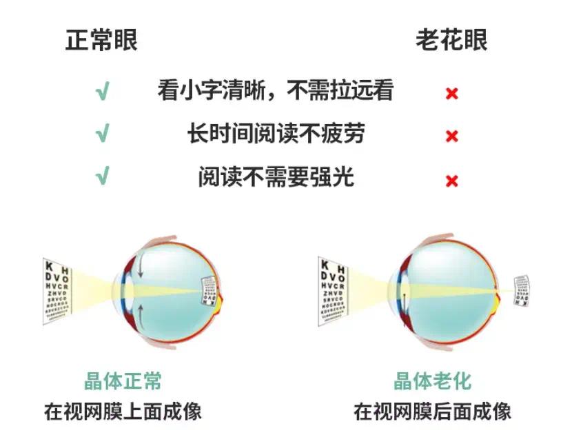 老花和近视可相互“抵消”？背后的真相是……