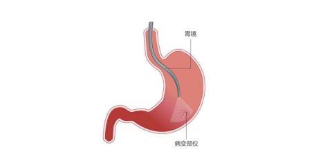 体检季 | 为什么要做胃镜？胃镜有何神奇之处？