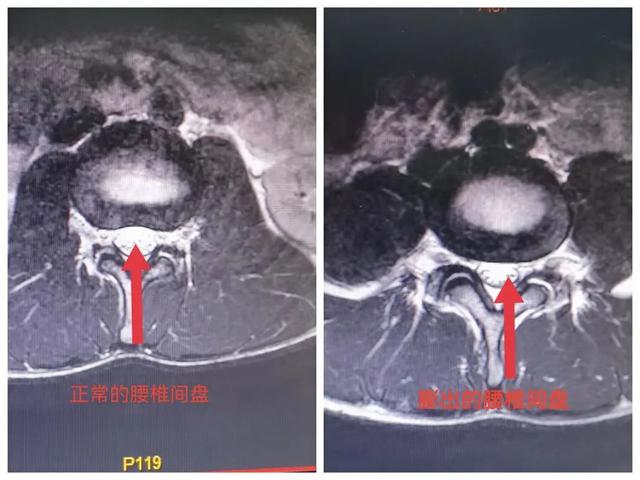 【提醒】18岁高三学子竟腰椎间盘突出！只因忽视了这件事