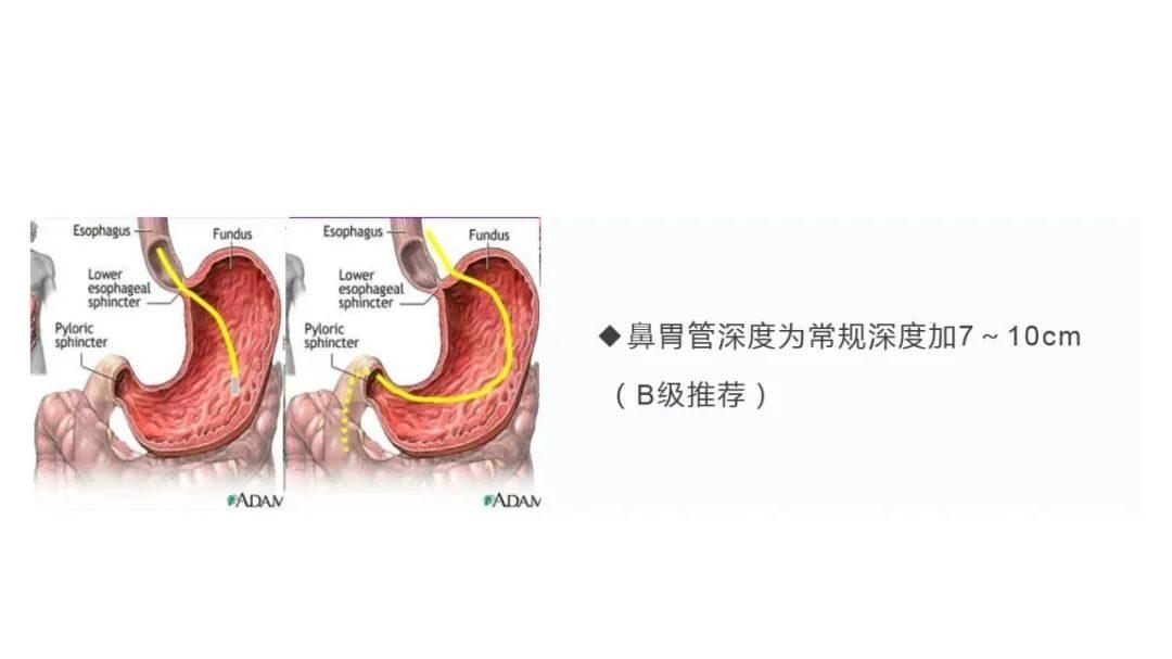 【PPT资源】人工气道管理