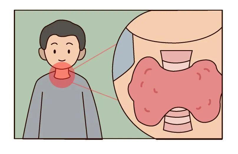 体检报告显示“甲状腺结节”，需要手术治疗吗？