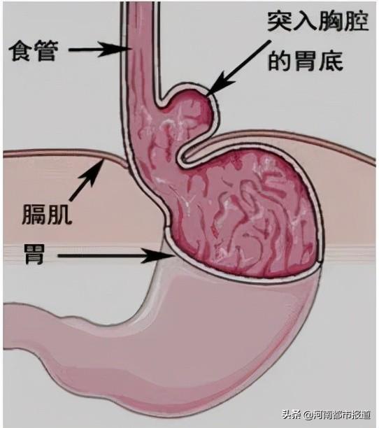 只要一吃饭就恶心，85岁的她胃“消失了”？