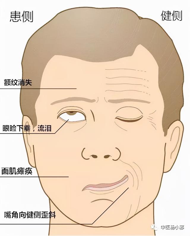 【护理科普】冷冬来袭 预防“面瘫”