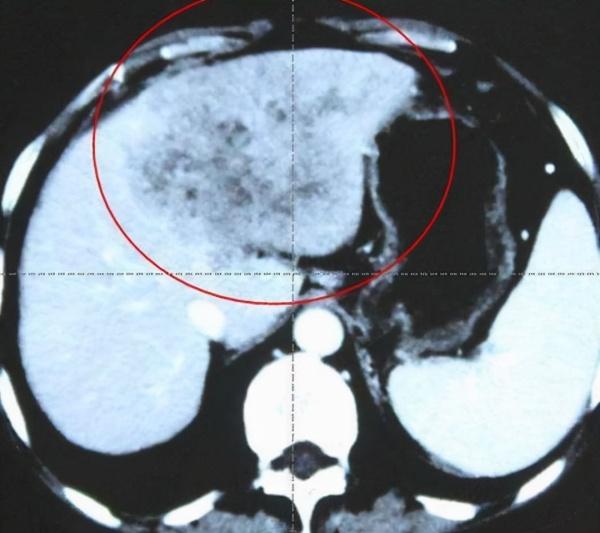 男子腹泻1个月，确诊肝癌，医生：上厕所时3异样，需警惕