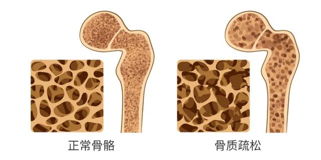 人老了就会得骨质疏松？不一定！这样饮食，骨骼常年轻！