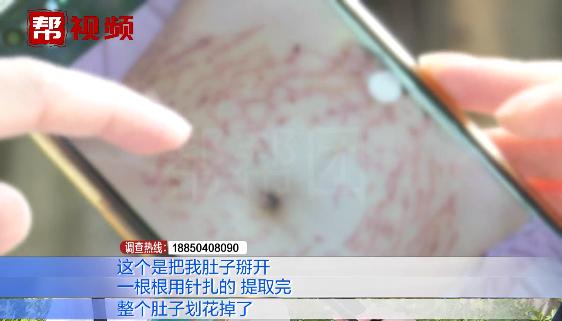 祛妊娠纹肚皮反被“刮花”？宝妈投诉纹管家：越做越糟糕