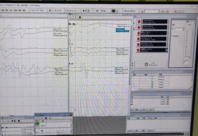 神经电生理监测技术，让外科手术更安全！