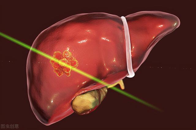 体检查出肝囊肿，怕转化成肝癌？这5种情况下，需及时治疗