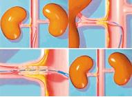 肾动脉血栓狭窄 介入治疗是首选