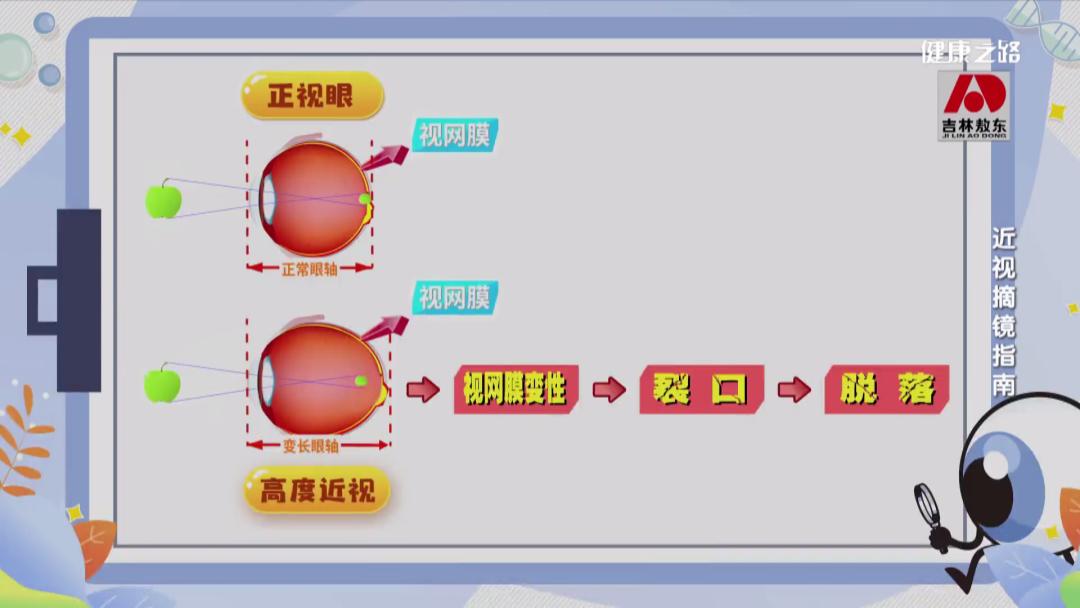 你想过在眼睛上动刀子是什么感觉吗？｜健康之路