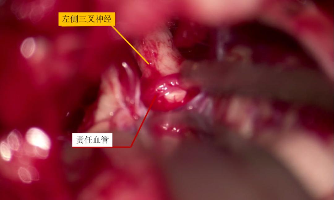 微血管减压术治疗颅神经疾病的经验与体会