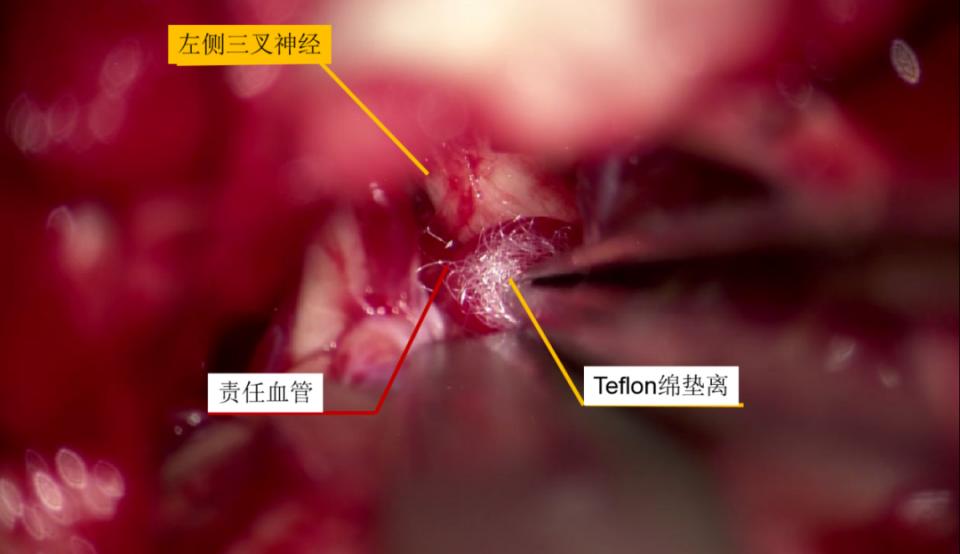 微血管减压术治疗颅神经疾病的经验与体会