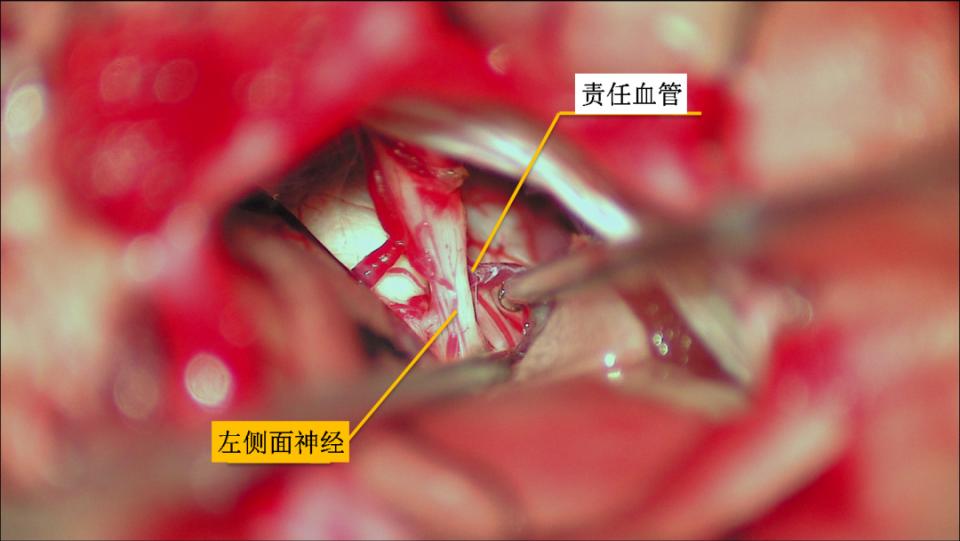 微血管减压术治疗颅神经疾病的经验与体会