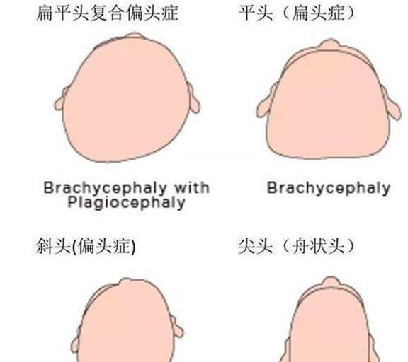 扁头审美已不合时宜，宝宝还是圆头好看，家长该摒弃不科学的习俗