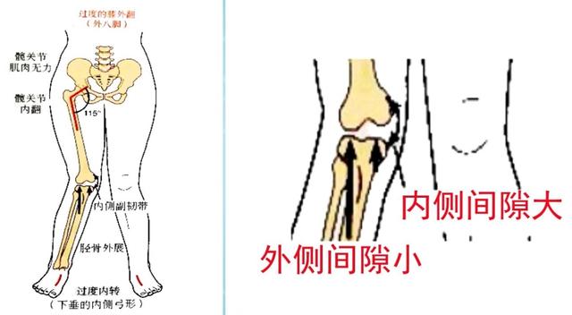 X型腿“遇见”物理治疗，蠢蠢欲“动”