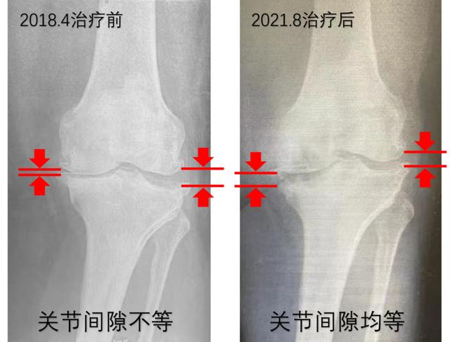 中国医疗队“膝”心照料令安妮塔重拾生活信心 | 庆党的百年华诞 讲百篇援外故事