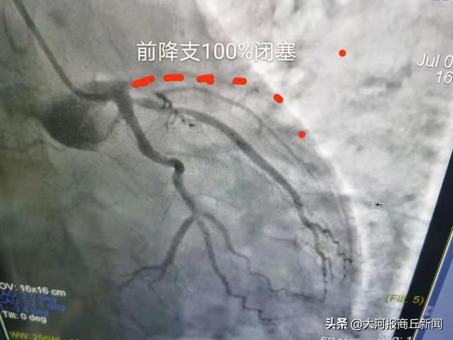 与时间赛跑——商丘市中医院成功救治急性心梗患者