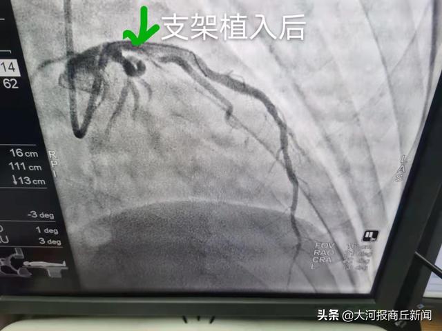 与时间赛跑——商丘市中医院成功救治急性心梗患者