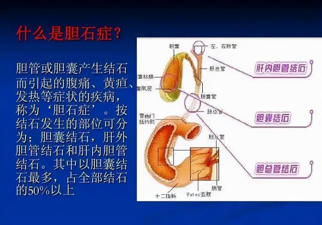 科普 | 吃出来的「胆结石」怎么吃回去？