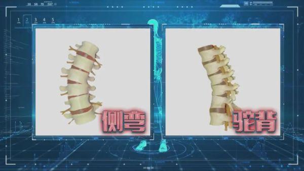 身体“折叠”有隐情，专家带你了解脊柱侧弯！｜健康之路