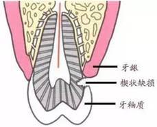 一个刷牙好习惯，害她22颗牙全坏！可怕的是很多人每天都在做