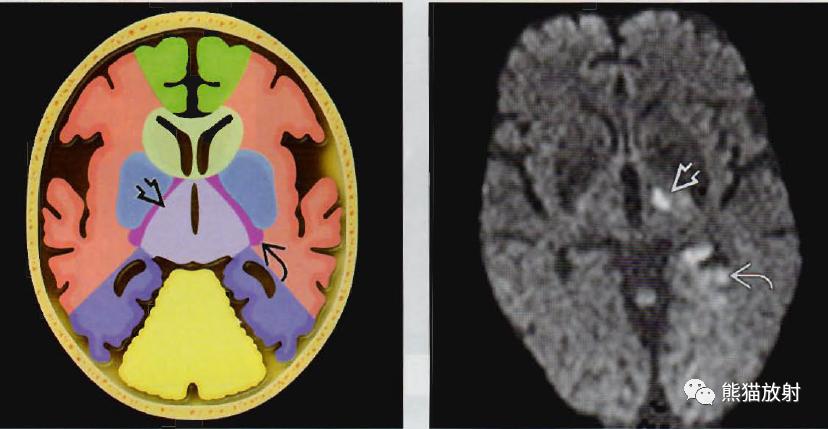 几种特殊部位脑梗死丨影像诊断要点解读